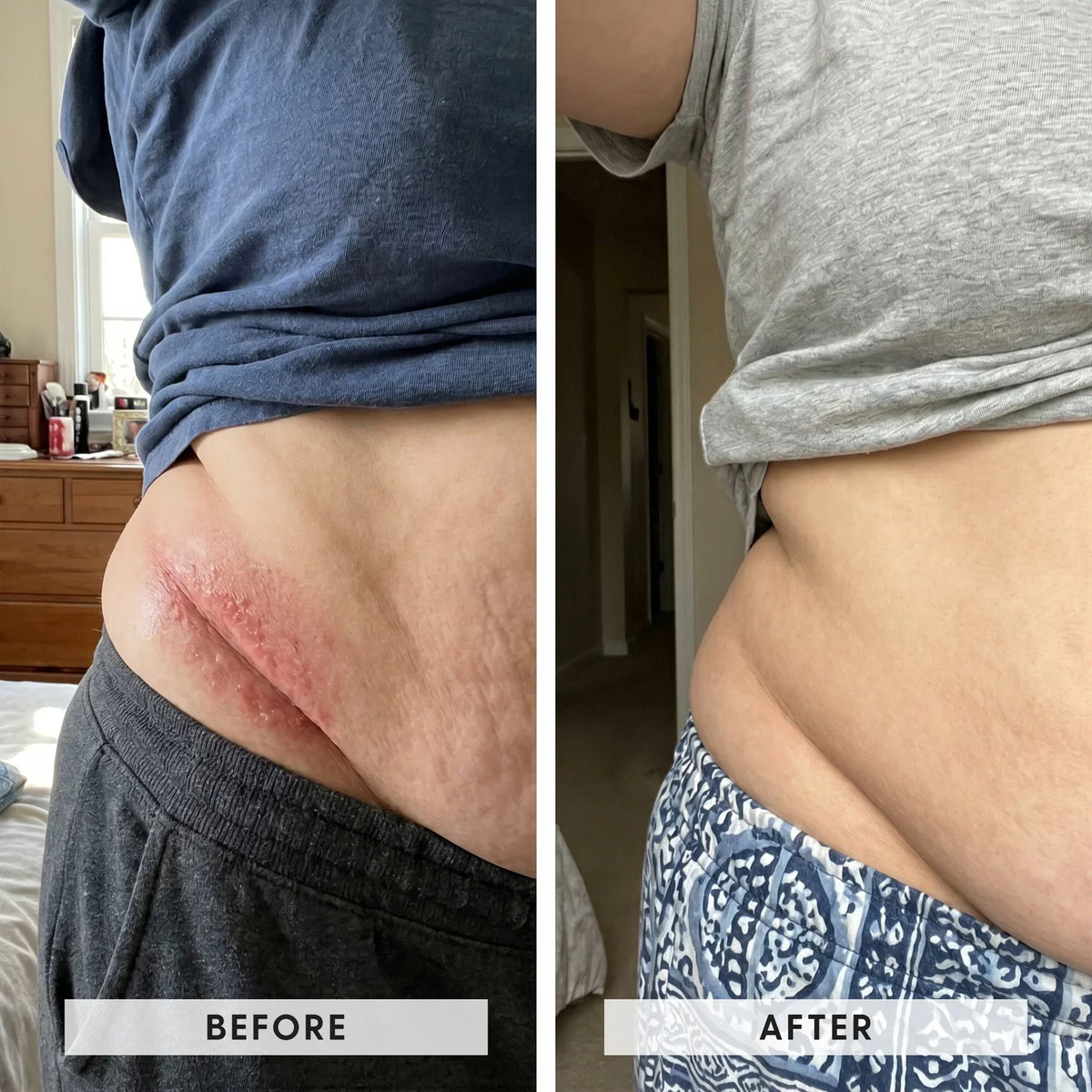 Seravinn™ Intertrigo Cream