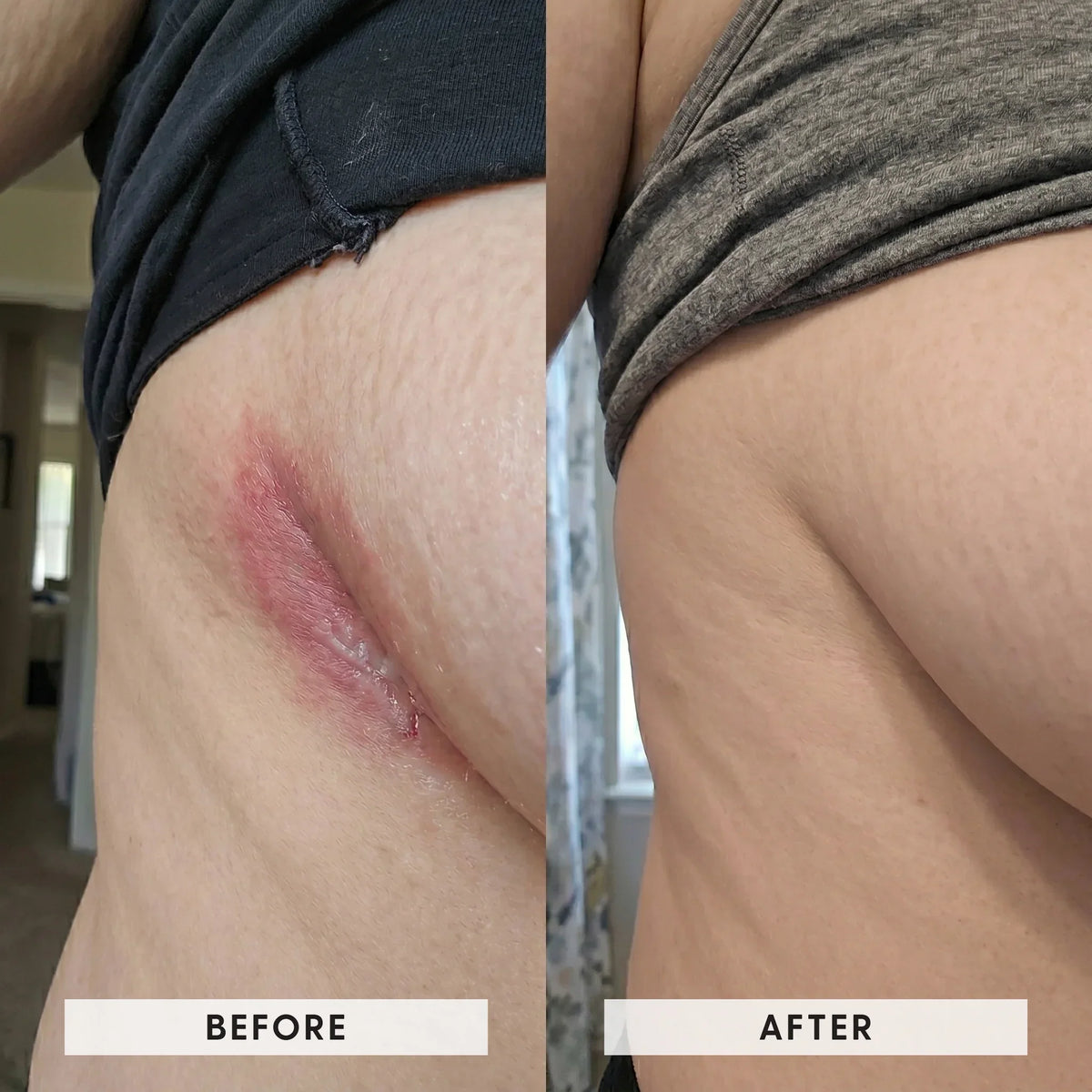 Seravinn™ Intertrigo Cream